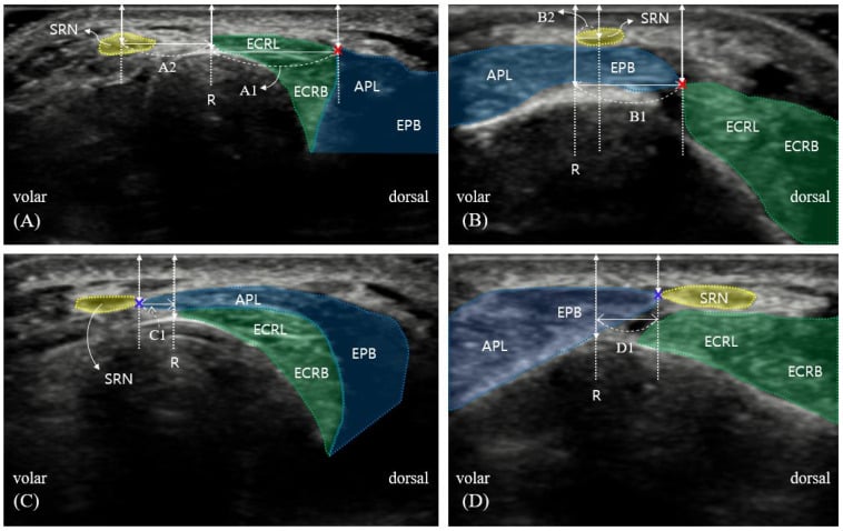 Ultrasound map of intersection tendons and the superficial radial nerve
