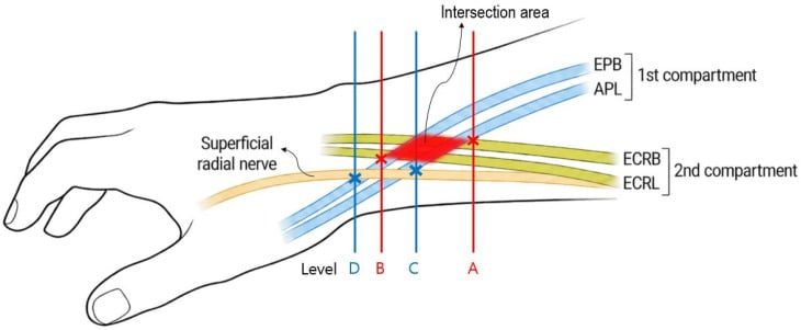 Anatomical relationship of the first and second extensor compartments and superficial radial nerve
