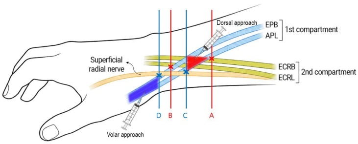 Dorsal and volar needle approaches around the proximal intersection