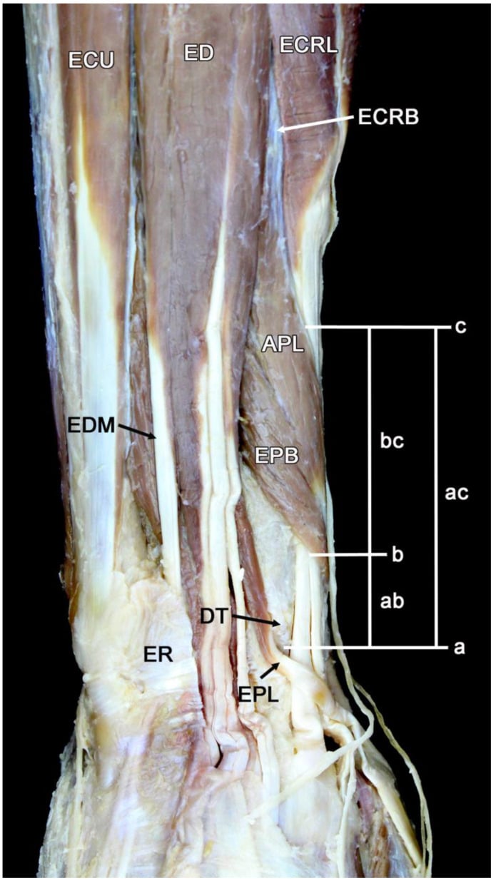 Cadaveric dorsal dissection of the proximal intersection