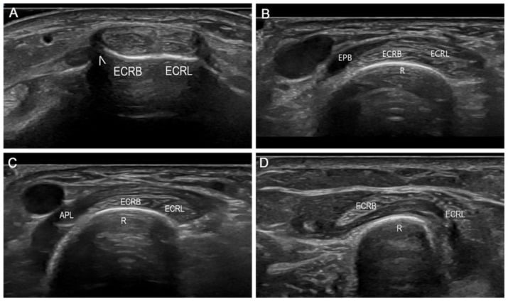 Serial transverse ultrasound through the proximal intersection
