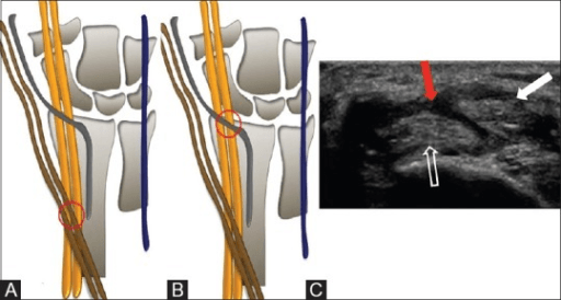 Three-panel composite: two schematic drawings of proximal and distal intersection points and one ultrasound image