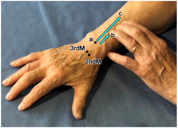 Surface landmarks for locating the forearm intersection