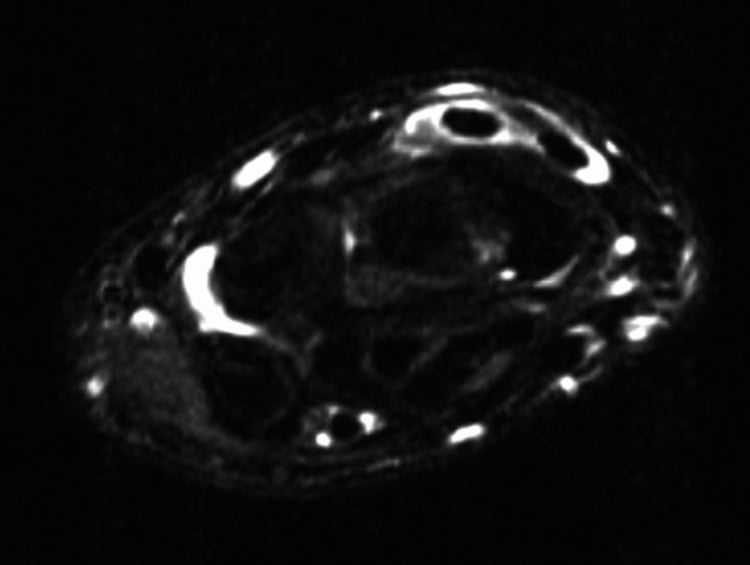 Axial MRI of distal intersection syndrome involving EPL and the second compartment