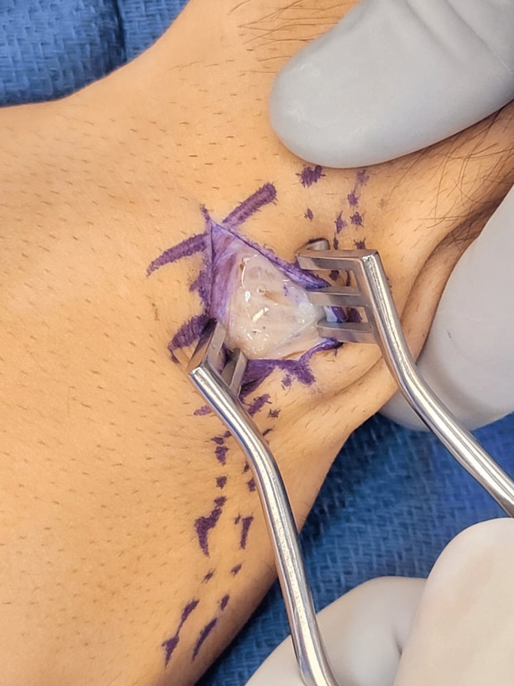 Operative decompression of severe intersection tenosynovitis