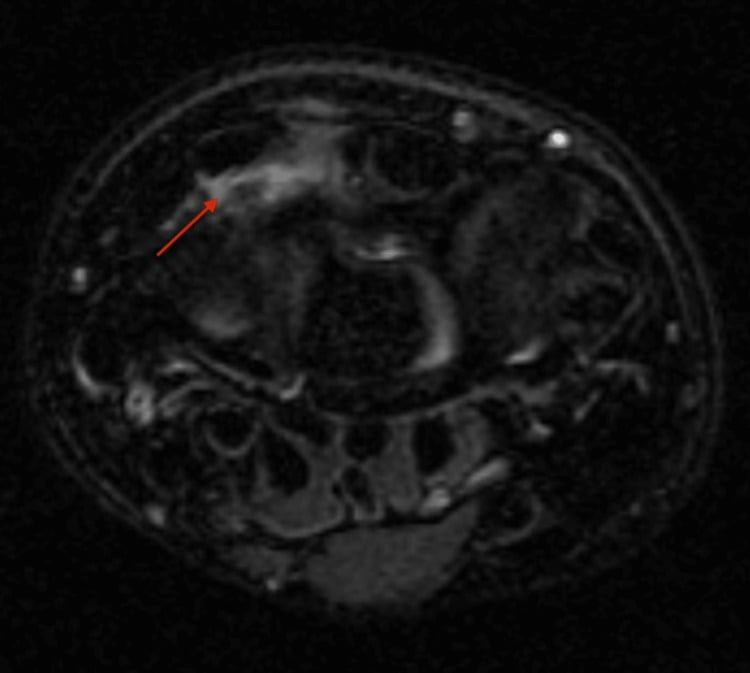 MRI showing peritendinous oedema around the second and third extensor compartments