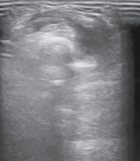 Axial greyscale ultrasound of the dorsoradial forearm showing a hypoechoic edematous halo around thickened tendons