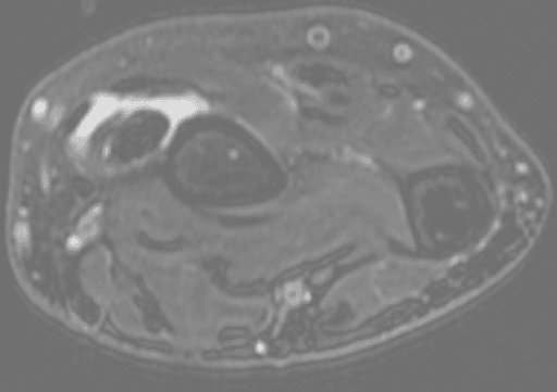 Axial fluid-sensitive MRI of the distal forearm showing bright peritendinous fluid around the dorsal extensor tendons