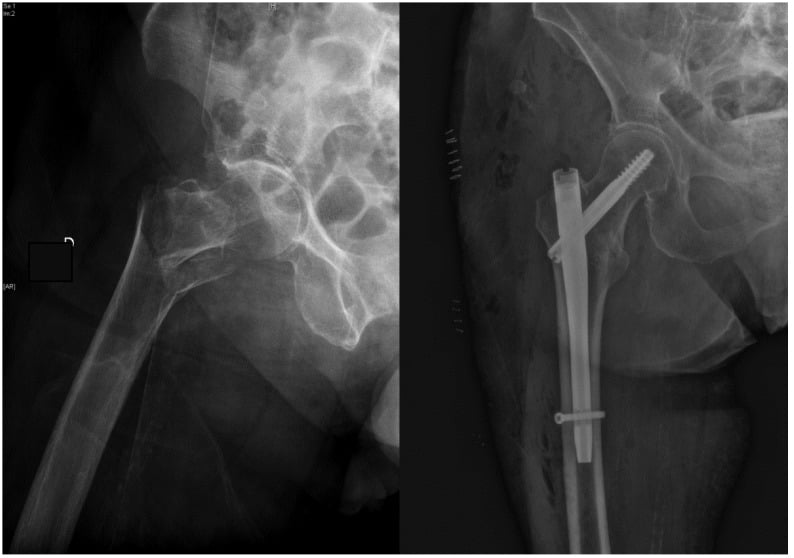 Pertrochanteric fracture fixed with Gamma3 cephalomedullary nail
