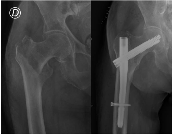 Pertrochanteric fracture fixed with InterTAN cephalomedullary nail