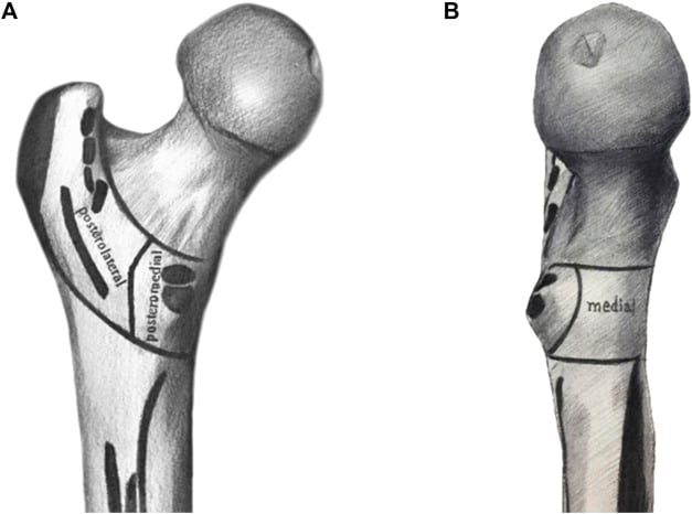 Anatomical diagram showing posterolateral, posteromedial, and medial structures of the proximal femur