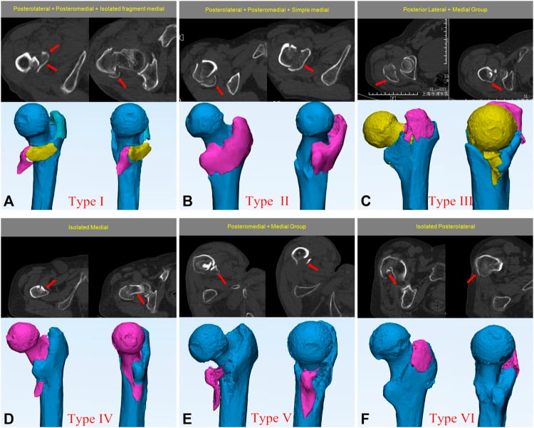 CT images showing intertrochanteric fracture patterns with posteromedial fragment classification