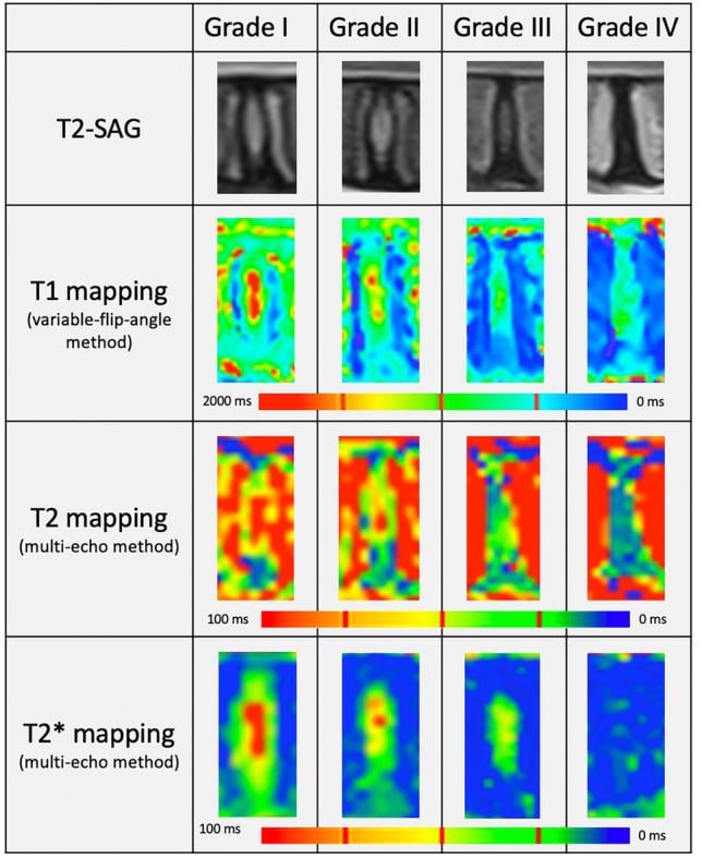 MRI T2-weighted and quantitative mapping images showing Pfirrmann grades I-IV