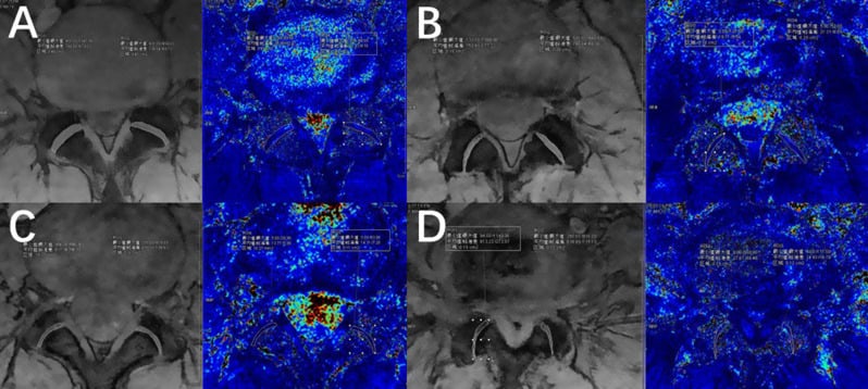 Clinical MRI cases showing disc and facet joint degeneration with T2* mapping