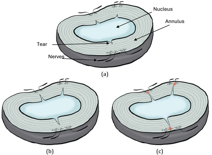 Three-panel diagram of an annular radial tear extending from the nucleus towards the nerves of the outer annulus