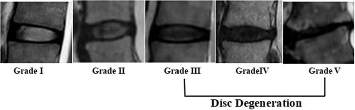 MRI examples of discs graded Pfirrmann I through V
