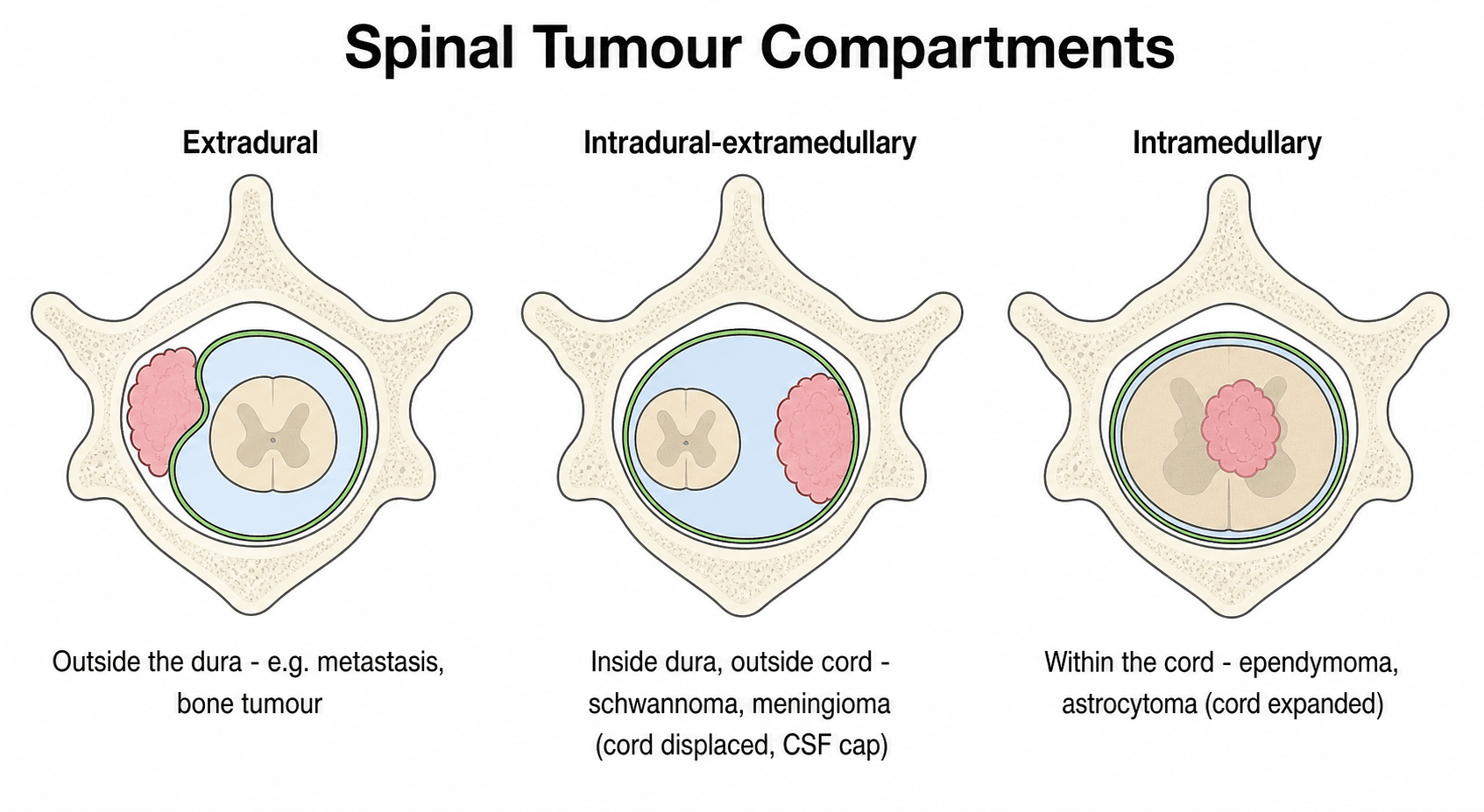 Three axial diagrams of the spinal canal showing an extradural tumour, an intradural-extramedullary tumour displacing the cord, and an intramedullary tumour expanding the cord.