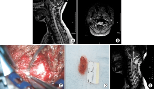 Multi-panel cervical intradural extramedullary schwannoma: MRI, intraoperative and gross-specimen images