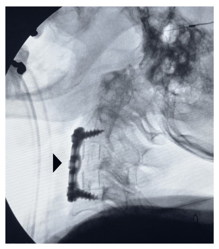 Intraoperative lateral fluoroscopy showing an anterior plate and screws with a posteriorly placed interbody cage