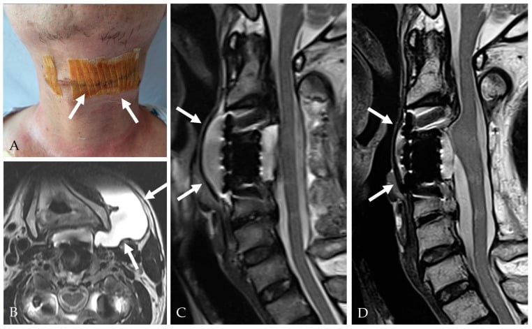 Neck swelling at thirteen days with MRI showing extensive CSF collection, then healing after revision closure and drainage