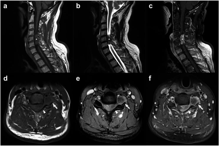 Sagittal and axial cervical MRI showing a C5-6 dumbbell meningioma with intradural and foraminal components
