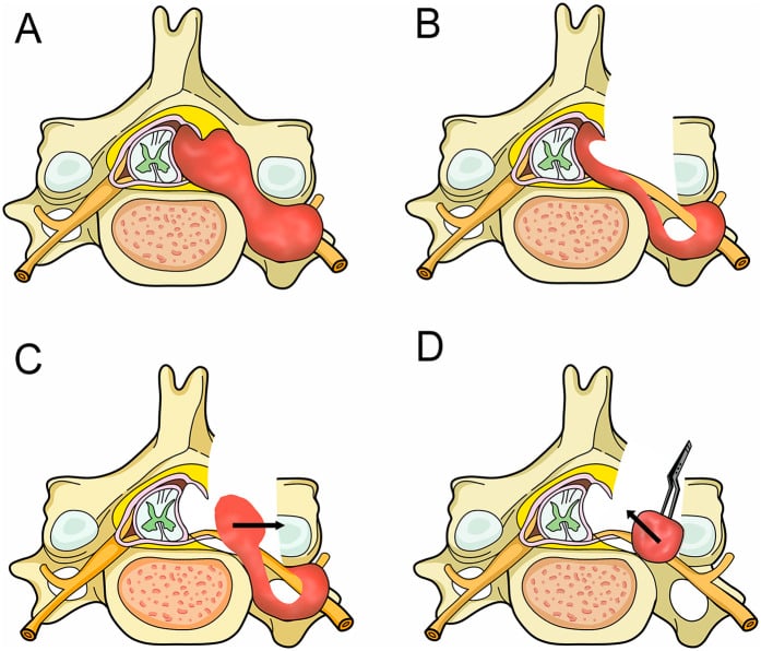 Surgical diagrams of hemilaminectomy exposure and staged removal of a dumbbell cervical tumour