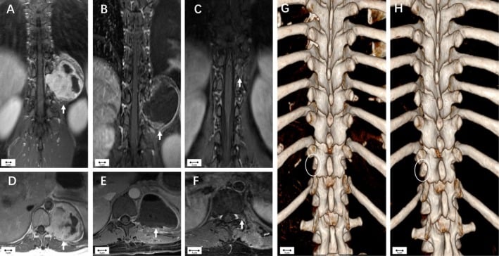 Pre- and postoperative enhanced MRI with 3D CT reconstructions of an Eden type IV paraspinal schwannoma at T11-12