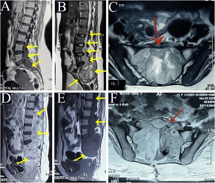 Sagittal and axial MRI of a giant multilobulated myxopapillary ependymoma extending from the conus to the sacrum