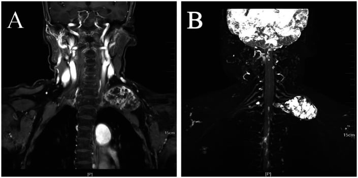 Conventional MRI beside a 3D-STIR-SPACE sequence showing tumour morphology and nerve course