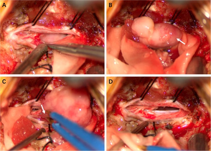 Intraoperative views of a mobile encapsulated intradural tumour with fascicles fused to the lesion, then complete resection
