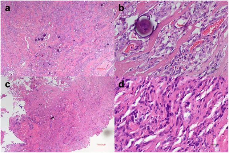 H&E histology of a transitional meningioma showing whorls and psammoma bodies at low and high power