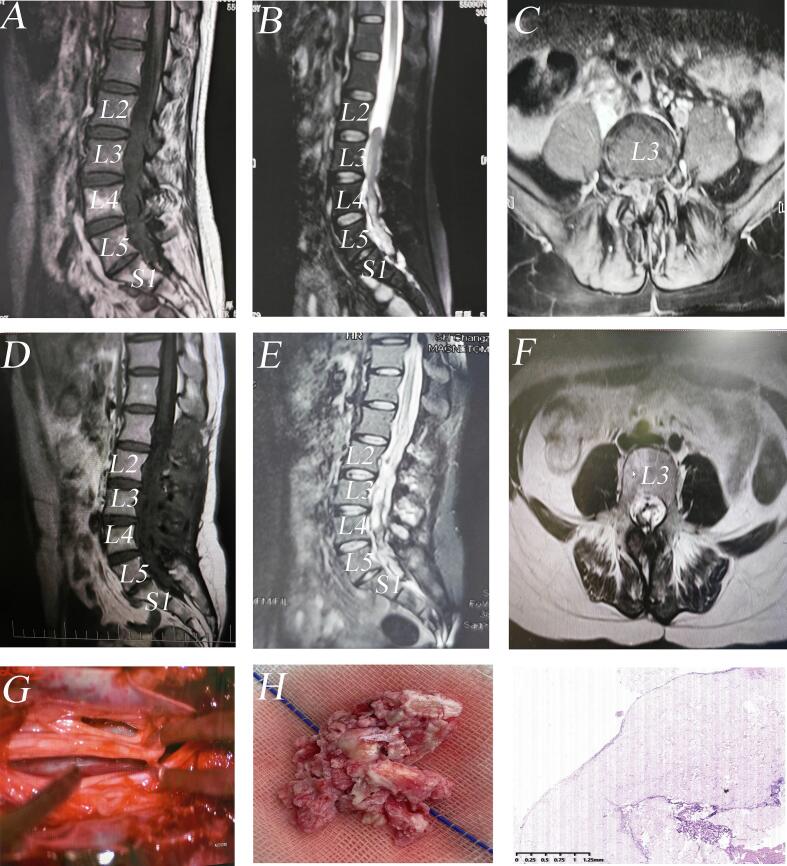 Pre- and postoperative sagittal T1, T2 and post-contrast MRI with axial views of an intradural lumbar mass