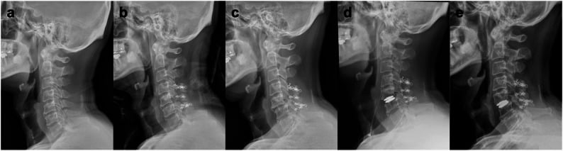 Sequential lateral cervical radiographs before, immediately after and late following staged dumbbell resection with facetectomy