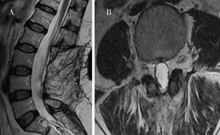 Postoperative sagittal and axial MRI showing restored CSF signal and no residual intradural mass