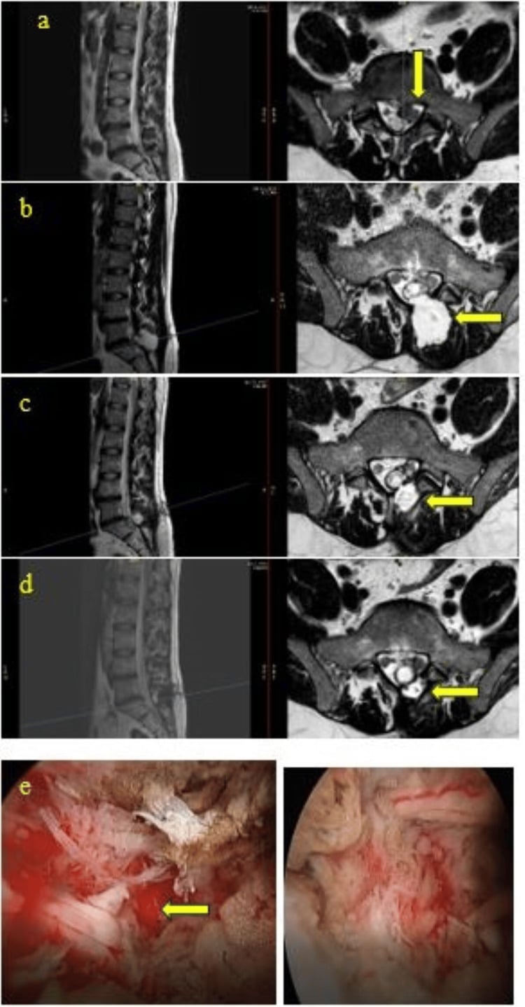 Serial axial and sagittal T2 MRI showing a large pseudomeningocele after dural tear and incomplete repair