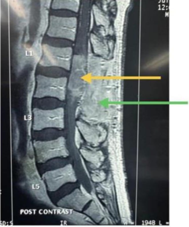 Post-contrast T1 MRI at six months showing recurrent enhancing tumour within the laminectomy defect