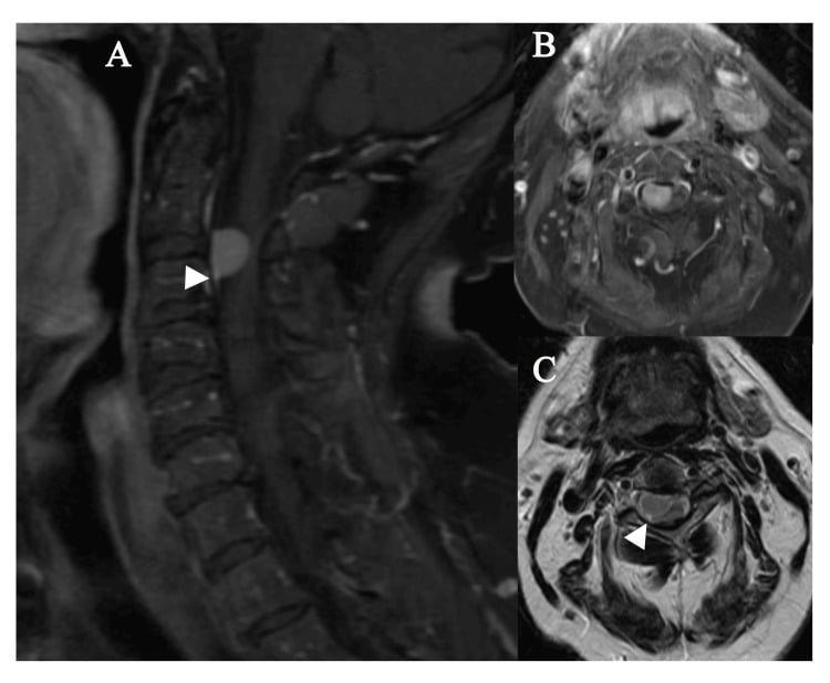 Sagittal and axial post-gadolinium MRI of a ventral spinal meningioma with a dural tail and severe canal compromise