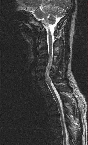 Sagittal cervical spine MRI showing an intramedullary spinal cord tumour expanding the cord, an ependymoma.