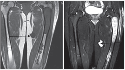 Coronal MRI of both thighs showing an intramuscular myxoid mass