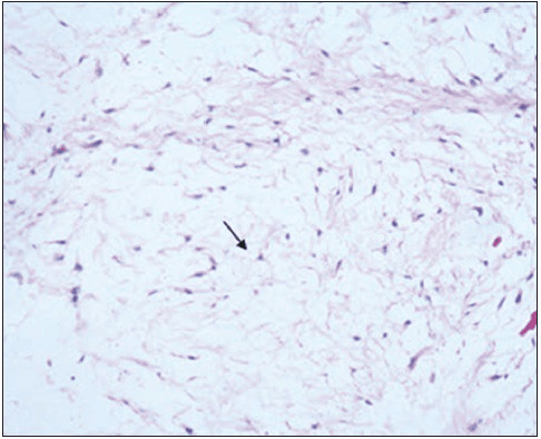 H&E photomicrograph of intramuscular myxoma showing a hypocellular myxoid tumour