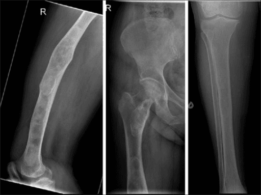 Plain radiographs of femur and pelvis showing polyostotic fibrous dysplasia