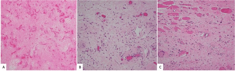 Histology panels of aggressive angiomyxoma showing myxoid stroma, varied vessels and infiltrated muscle.