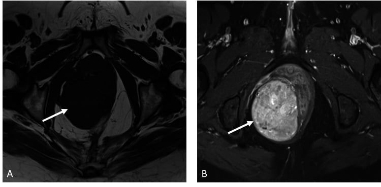 Paired axial T1 and post-contrast MRI of an aggressive angiomyxoma showing avid enhancement.