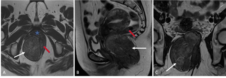 Axial, sagittal and coronal T2 MRI of a right ischiorectal-fossa aggressive angiomyxoma.