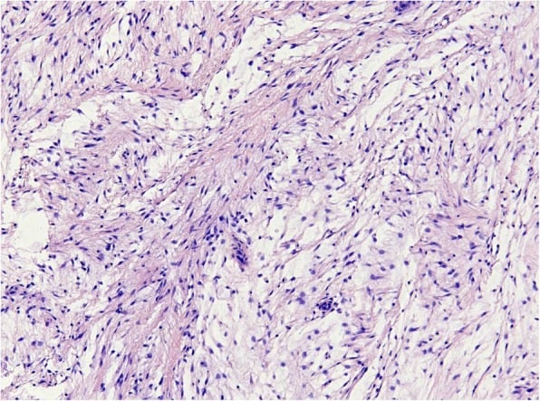 Histology of a cellular intramuscular myxoma showing bland spindle and stellate cells in myxoid stroma.