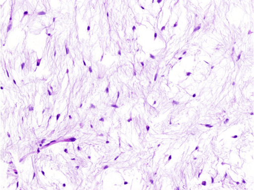 Histology of classic intramuscular myxoma with sparse bland stellate cells in abundant myxoid stroma.