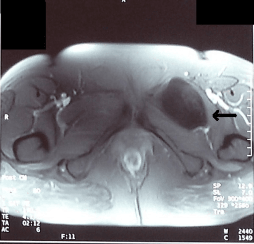 Axial T1 MRI showing a low-signal intramuscular myxoma in the left groin.