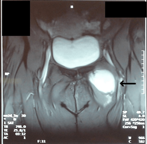 Coronal T2 MRI showing a bright intramuscular myxoma in the left groin.