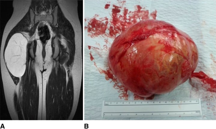 Coronal hip MRI and gross specimen of a juxta-articular myxoma.