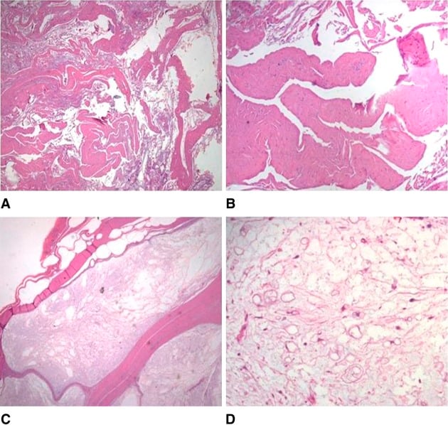 Histology panels of juxta-articular myxoma showing cystic spaces and bland cells in myxoid matrix.